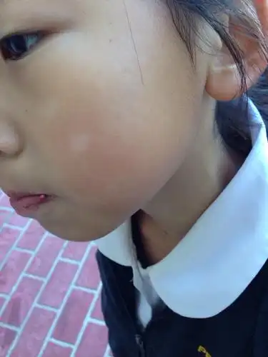 问:八岁女孩脸上出现的白点,是白癜风吗?