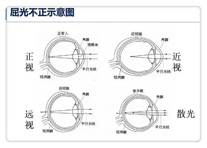 我们身边常见眼病就是近视,远视,弱视,斜视,先天性的角膜混浊等