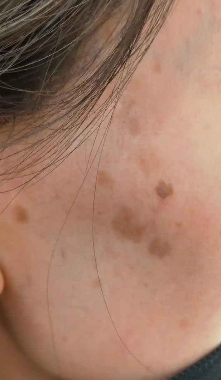 面部黑褐色斑块症状考虑脂溢性角化/老年斑.可以使用激光治疗去除.