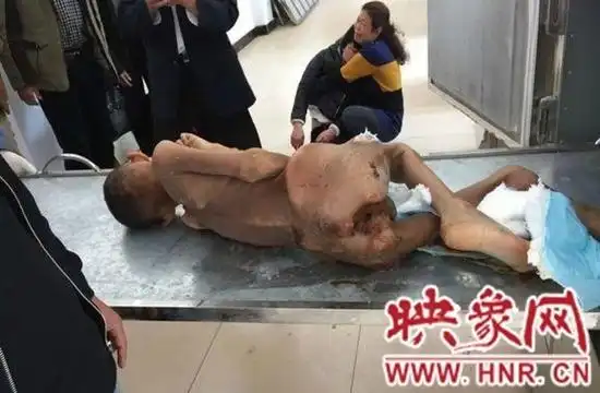 干尸男童尸检:死于营养不良