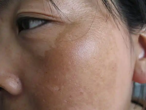 有黄褐斑的病因具体有哪些