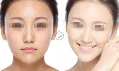 【美白针整容日记_美白针整形经验分享_整形前后对比照_葫芦岛颐正