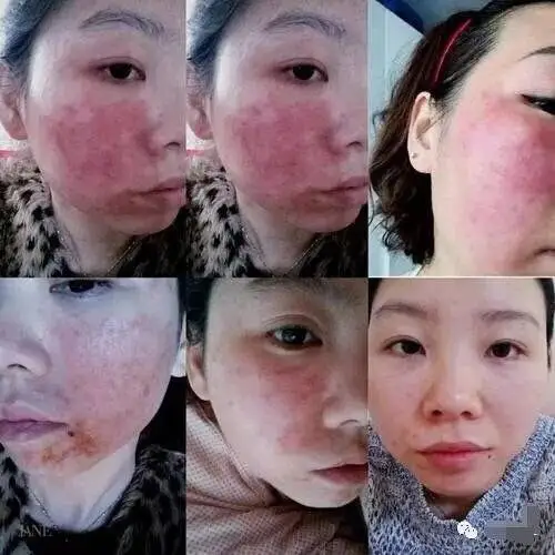 治疗激素脸为什么要排毒,为什么每个人排毒反应不一样?