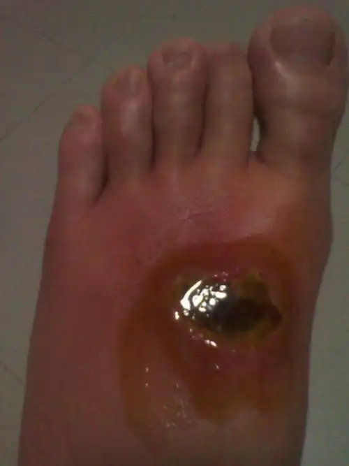 我的左脚背被50%浓度的氢氧化钠烧伤,现在用药(美宝