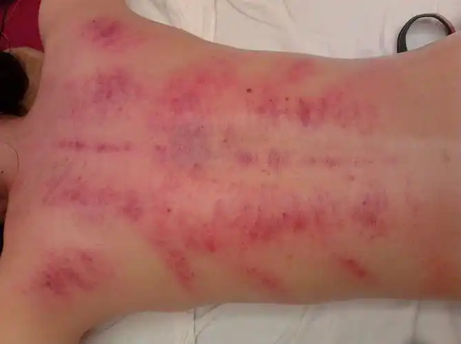 麻烦有关医学人士帮我看看,下图是今天刮痧拍的照片,我身体哪里出了