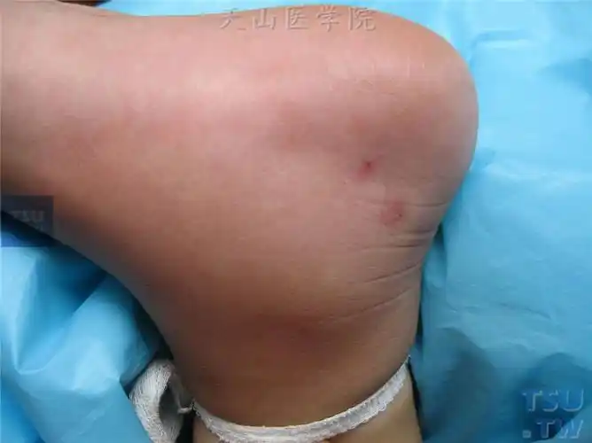 蜈蚣咬伤的症状表现