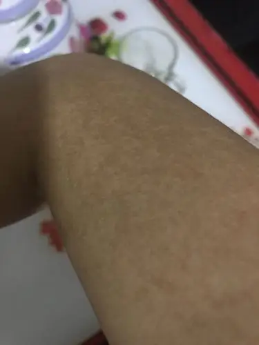 这是汗斑么,长在胳膊上尴尬啊