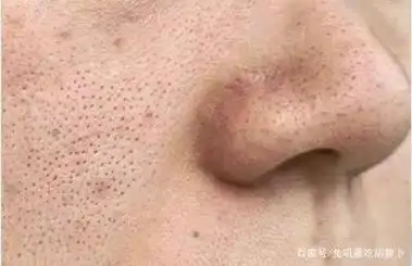 角质型毛孔粗大