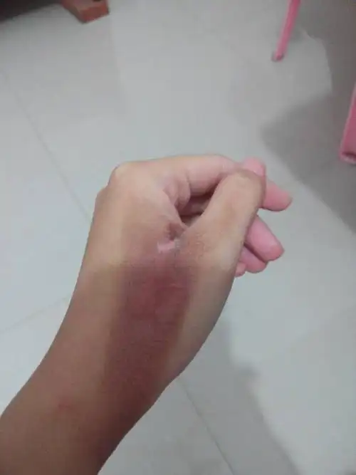 我的手一个多星期前被开水烫到了,因为之前也没有被烫到过,就以为没