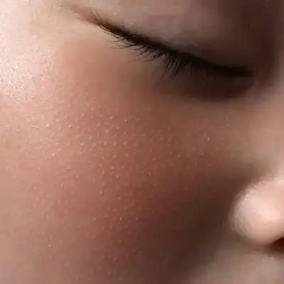 娃儿脸上长的这个白点点是什么呢?像毛孔一样,两边脸都有!_宝宝树