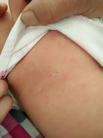 宝宝两个月了,后背上长一些像藓一样的东西,目前宝