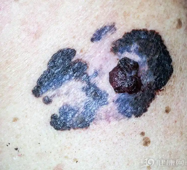 黑痣符合4个特征,或许是皮肤癌前兆,请做好心理准备