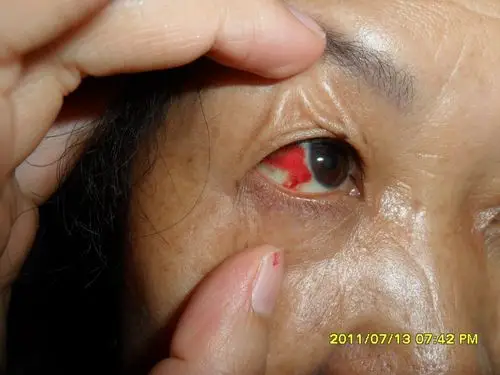 急急急,求助,我妈妈眼睛白眼球上出现大片血块,怎么回事?