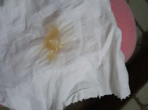 女人有这4种样子的白带当心宫颈癌现在防癌还来得及