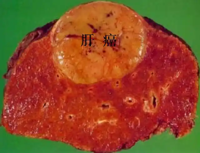 原发性肝癌指原发于肝脏的恶性肿瘤,区别于从其他部位转移至肝脏的