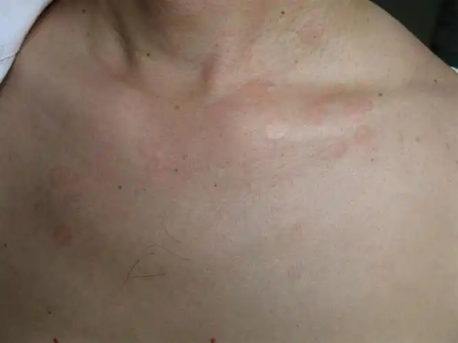 看图识病都是汗斑吗为啥不一样