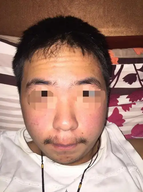 皮肤非常不好 男生18岁 脸上坑坑洼洼 看起来很邋遢 看起来特别老 有