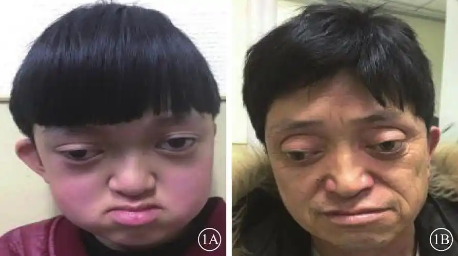 crouzon综合征一例