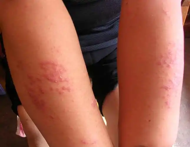 【求助】四肢及胸背部斑丘疹 - 皮肤性病 -丁香园论坛