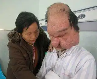 盘点全球最恐怖的50种怪病 - 猎奇图片 - 天极图片手机版