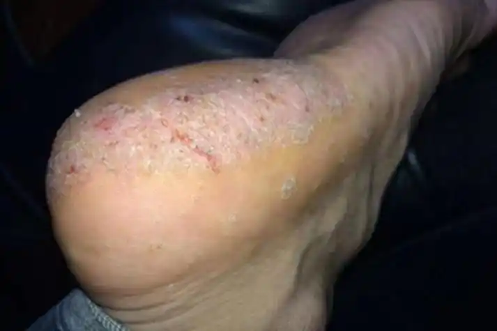 鳞屑角化型足癣脚后跟症状图