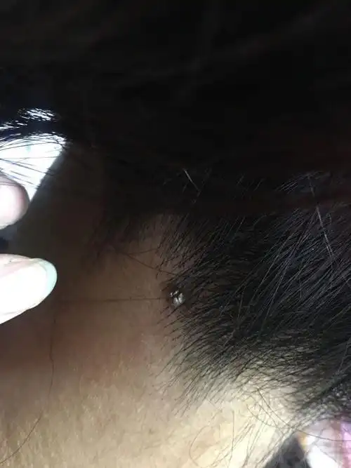 脖子上长一个个小黑色疙瘩像痣一样的东西 不疼