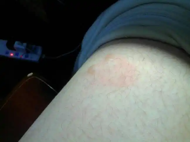 被暖宝宝烫伤了,晚上起了两个泡,怎么办?谢谢!