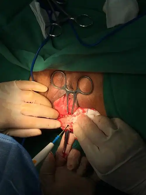 切开直肠阴道瘘至外阴形成三度裂伤.