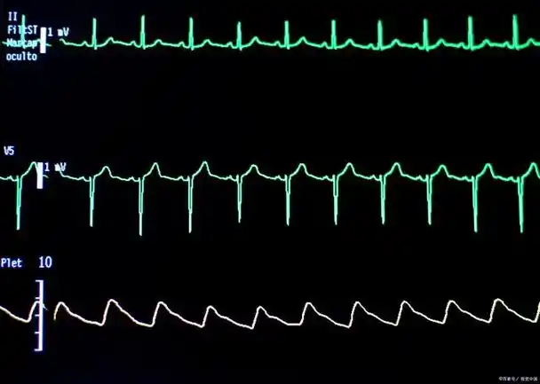 体检查出"窦性心律"是啥意思?心律不齐是心脏病吗?一文说清楚