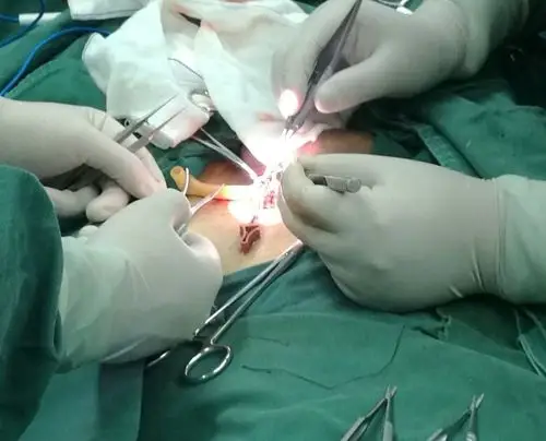 精索静脉显微结扎手术的优势