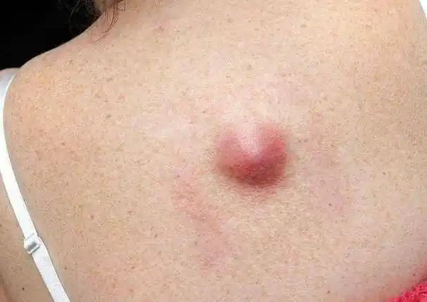 医生建议:皮肤出现4种异常情况,可能是癌症的征兆_治疗_症状_进行