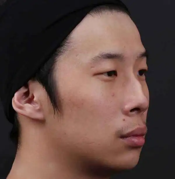 有点像骆驼的驼峰,所以起名叫驼峰鼻,而且是男女均有,并且只有在侧脸