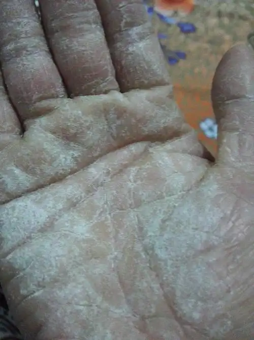 我双手掌,好痒,皮硬,开裂