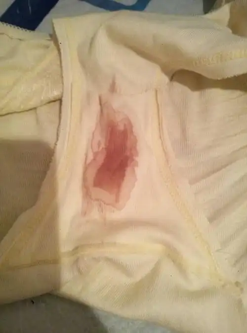 早上上厕所发现内裤上出现褐色分泌物,有点像大姨妈刚来的时候,什么