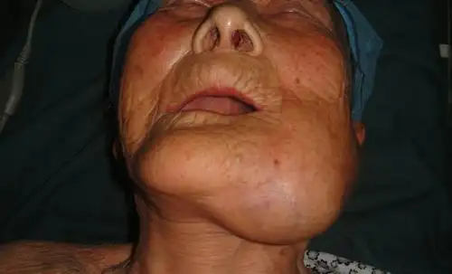 合肥研究院医院成功为91岁老人实施左下颌骨巨细胞瘤