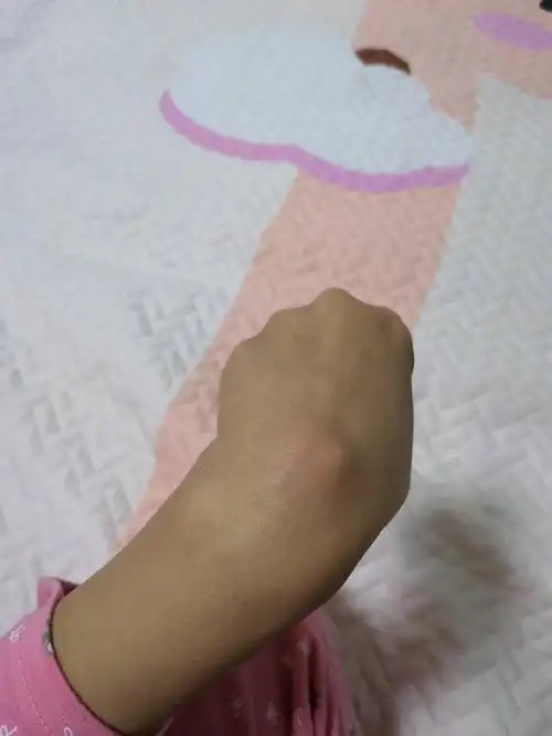 手腕长了一个囊肿似的包,是腱鞘炎吗