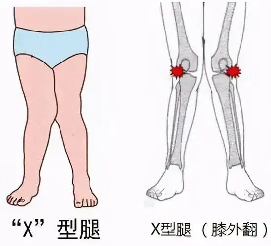 其中,双膝关节外翻畸形叫做x型腿,单膝外翻畸形叫做k型腿.