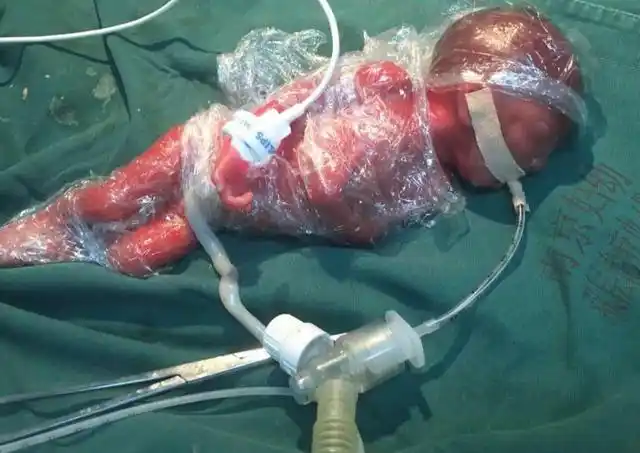 "巴掌宝宝"出生时只有1斤多,南京市妇幼成功救治22周超早产儿