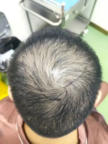 男士m额角 头顶o型区加密案例,男士谢顶脱发,油性头发,毛发细软植发