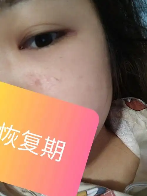 果酸换肤后第三天脸颊结痂掉了一些看着没有前两天吓人了果酸换肤的