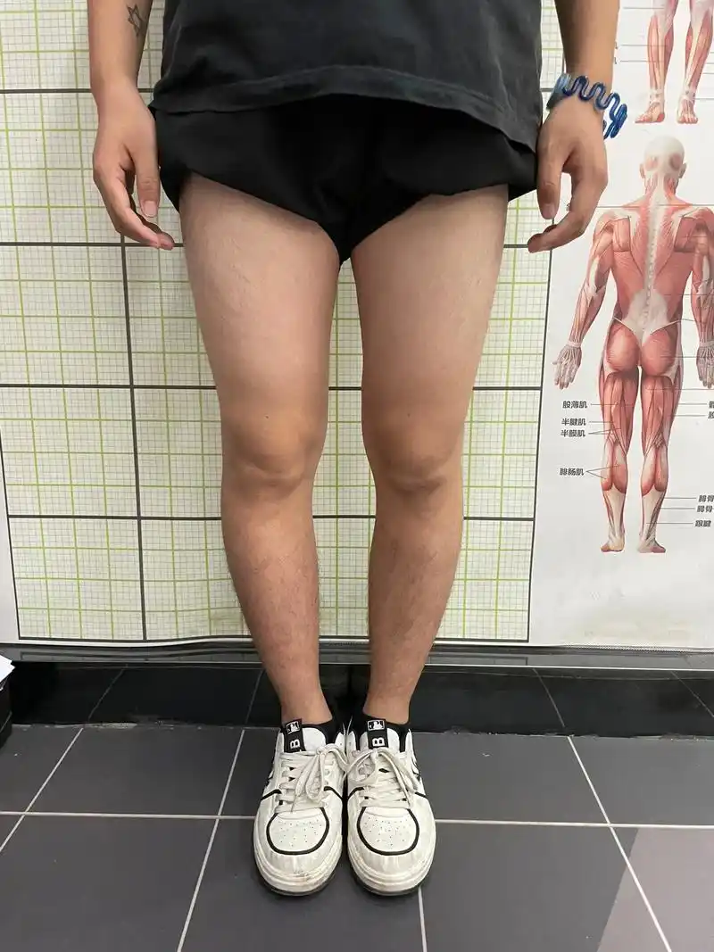 o型腿调整前后效果对比图 - 抖音
