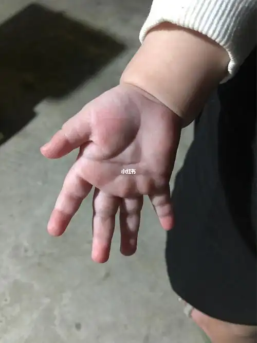 婴儿的手手都是这样的吗?