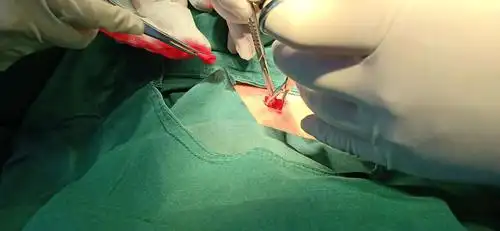 李集镇卫生院微创阑尾炎切出术