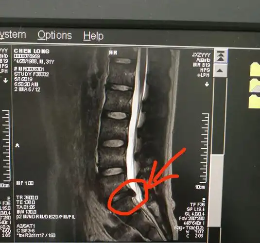 腰椎间盘突出无需手术!保守治疗效果秒杀手术少花几万块!