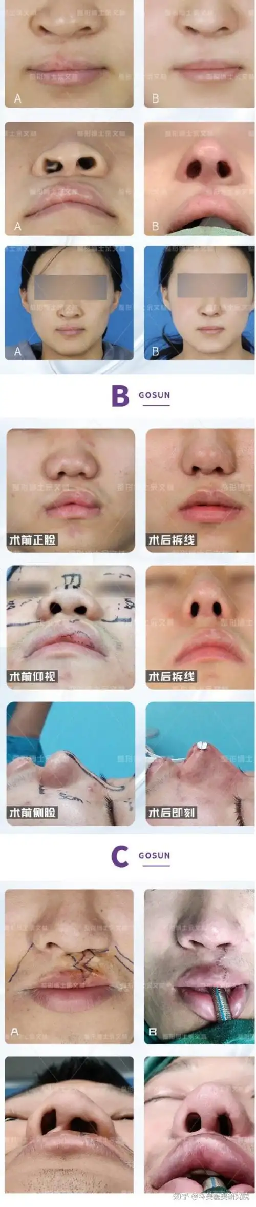 国内兔唇/唇腭裂二期正规整形医院排名前十:广州高尚,西安国际医学等