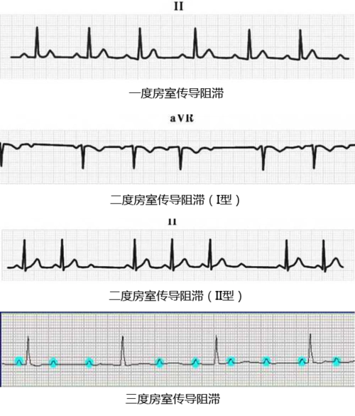 房室传导阻滞 - 对照表 - 安心网-专业心血管健康综合服务网站,好朋友