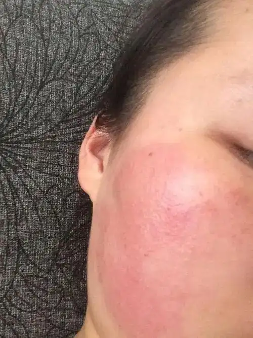 脸上过敏发红发痒怎么办最有效