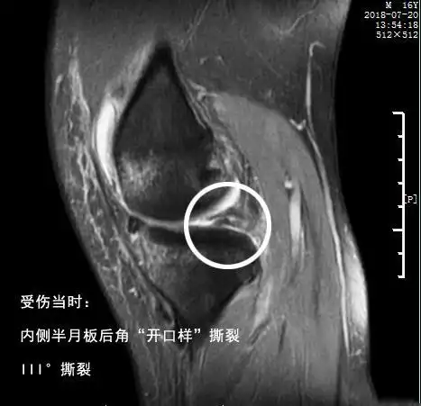 半月板撕裂保守还是手术医生决定保守有多难您可能不知道