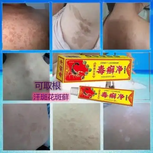去汗斑花斑膏成人皮肤外用汗斑大腿汗班藓花班皮肤专用癣乳膏白斑