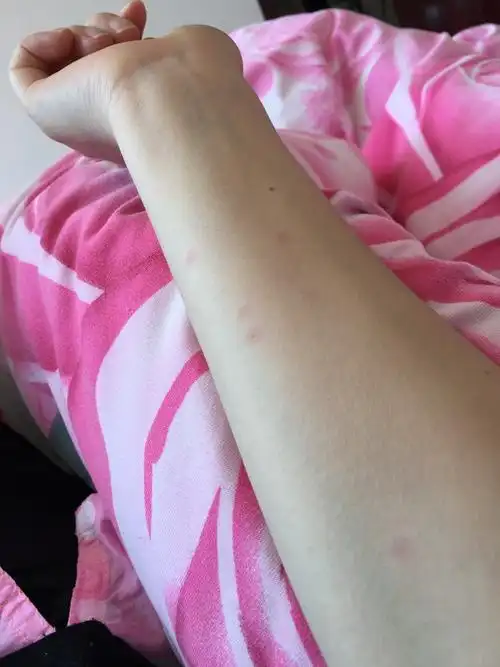 手臂上有一点点的小红点,有相同经历的宝妈吗?